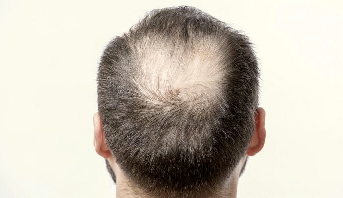 Beeinflusst Meine Frisur Die Wirkung Der Haarausfallbehandlung?
