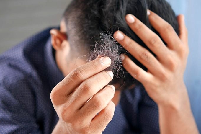 Die 7 Arten Von Alopezie: Wie Man Sie Behandelt