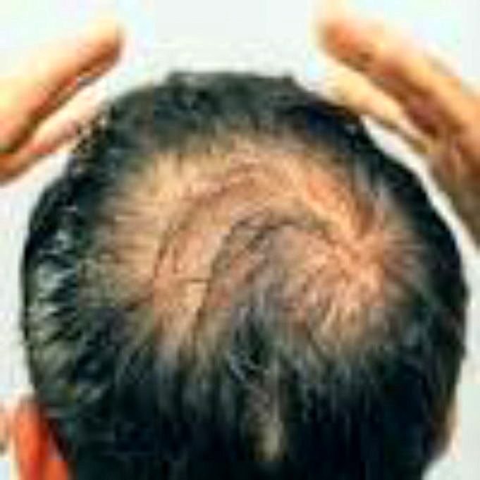 Was Verursacht Haarausfall. Symptome Und Behandlung Von Haarausfall